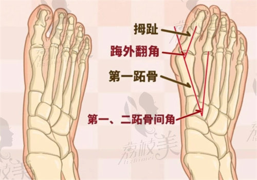 马桂文做大脚骨手术多少钱