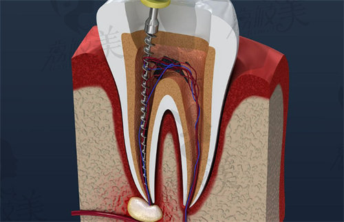 大连根管治疗哪家好