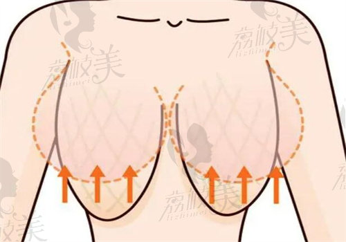 徐国建医生主打乳沟聚拢黄金2cm技术