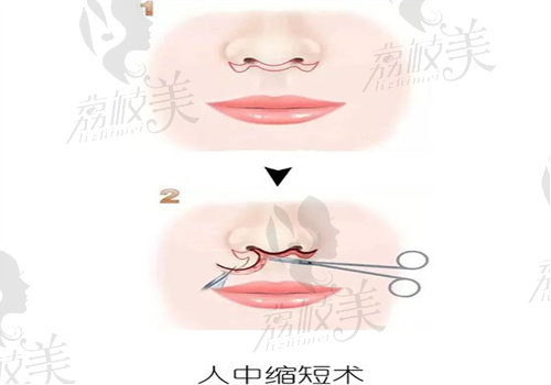 上海沪西医院管果医生人中缩短价格：1W元起