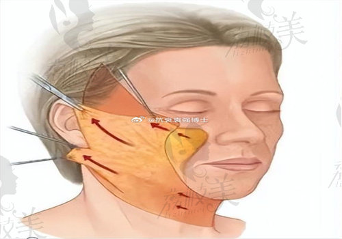 袁强博士拉皮手术实例