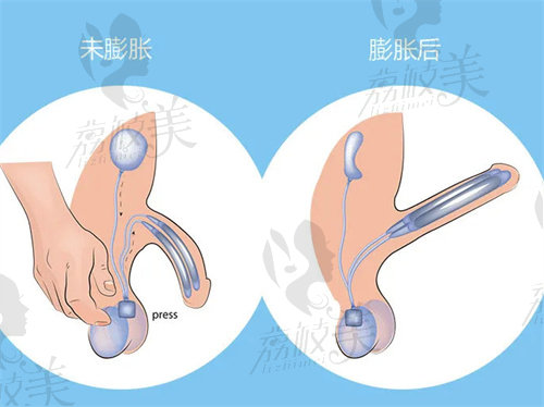 男性假體三件套植入多少錢