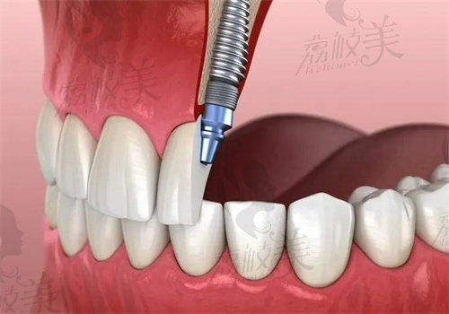 深圳格伦菲尔口腔医院种植牙做的好