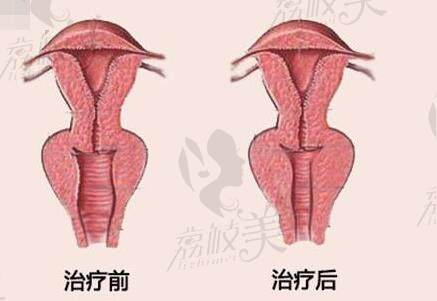 广州建国医院做的阴道紧缩术怎么样好不好