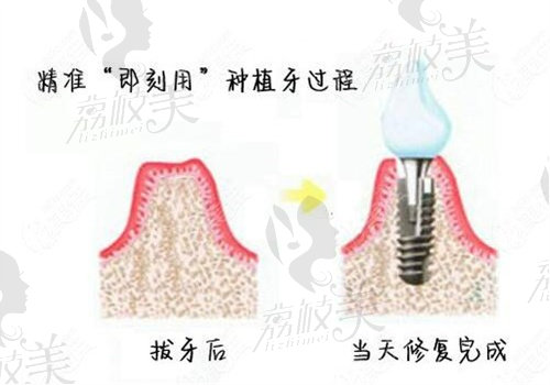 杭州好牙口腔种植医生