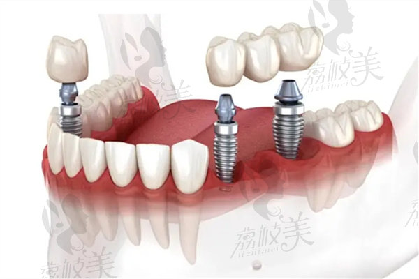 乌鲁木齐牙博士口腔医院种植牙怎么样