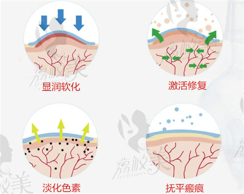 不同疤痕类型及对应祛疤方法