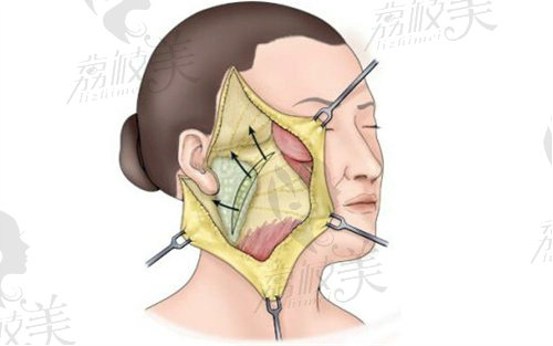 拉皮提升手术选杜太超还是李晓东好