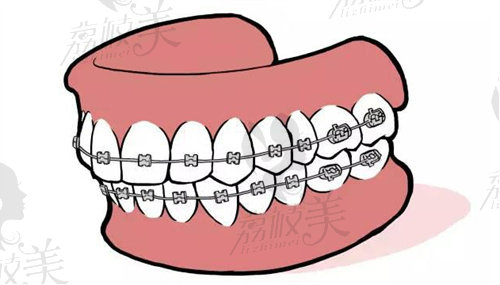 吉林的牙齿矫正价格