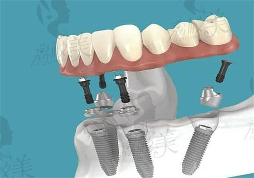 上海永博口腔医院种植牙价格表分