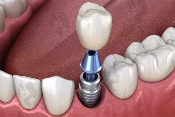 汕頭天佑口腔中心種植牙怎么樣