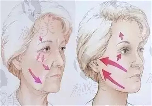 李建刚筋膜提升的口碑和用户评价.jpg