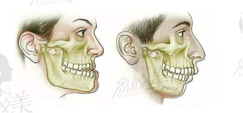 广州韩妃王涛正颌手术价格