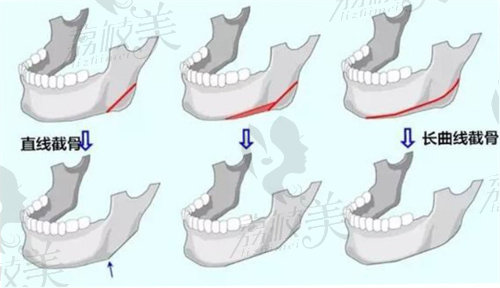 廣州韓妃柳超長曲線下頜角手術(shù)價格