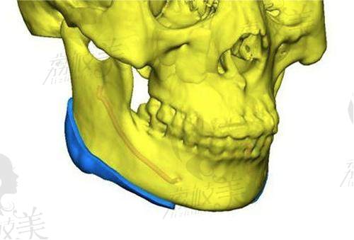 廣州韓妃柳超長曲線下頜角磨骨手術(shù)怎么樣