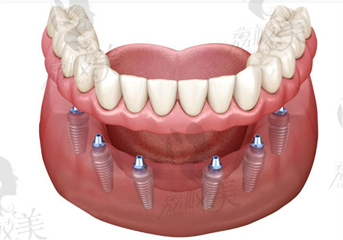 全口半口种植牙方式有几种