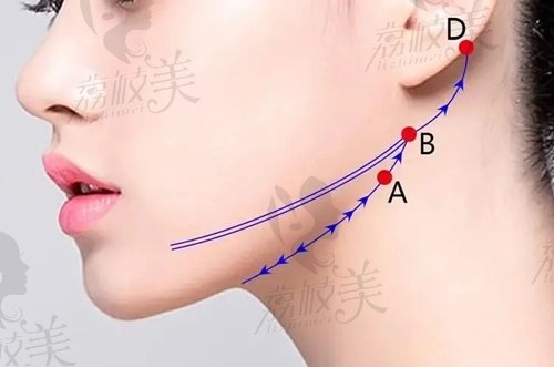 深圳八大處賈振華醫(yī)生中下面部拉皮手術(shù)怎么樣？