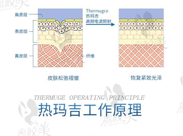 天津做熱瑪吉哪家醫(yī)院好