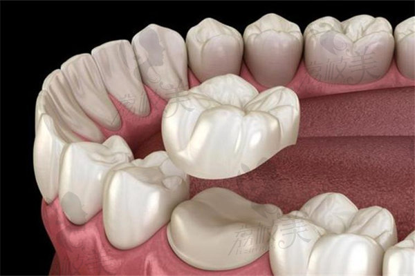 贛州貝殼口腔醫(yī)院牙冠怎么樣？