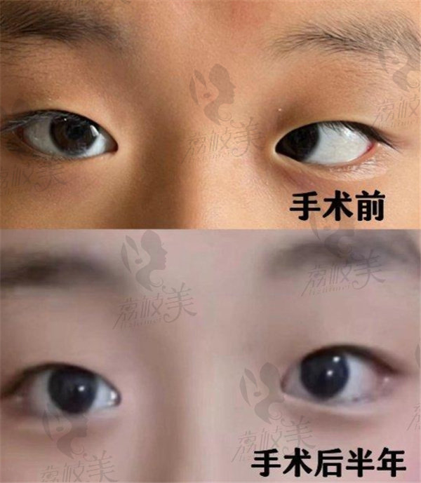 眼睛斜视做手术要多少钱