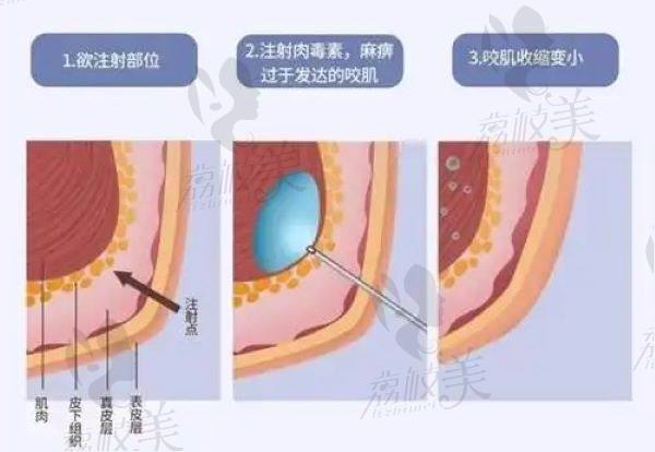 合肥打瘦脸 针多少钱