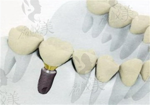 兰州惠安齿科种植医生介绍