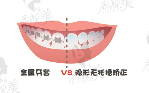 桂林牙齒矯正費用大概多少錢