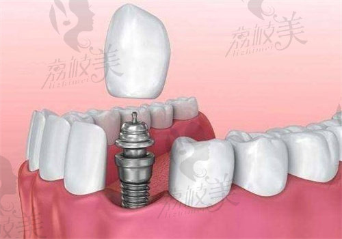 长春爱馨口腔医院种植牙怎么样