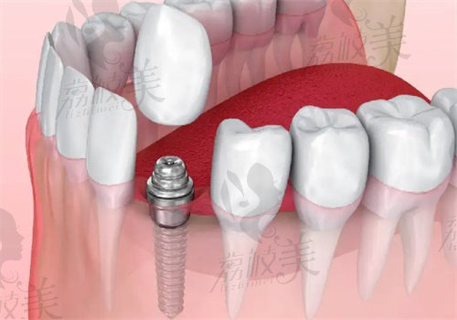 长春爱馨口腔医院种植牙怎么样