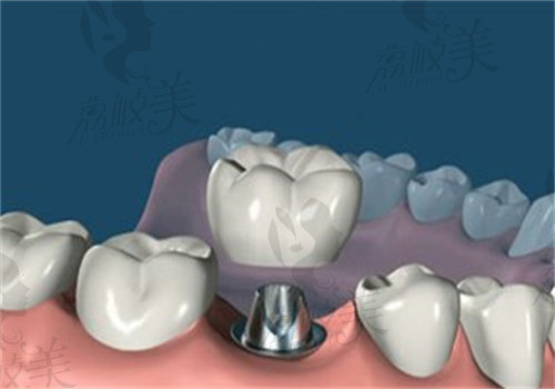 长春爱馨口腔医院种植牙怎么样