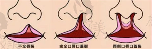 唇腭裂手術(shù)免費(fèi)在線申請(qǐng)