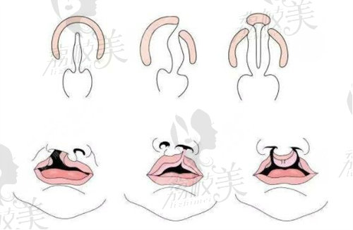 唇腭裂手術(shù)免費(fèi)申請(qǐng)流程