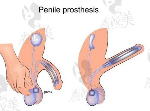 國內(nèi)男性陰莖假體植入好的醫(yī)院排名