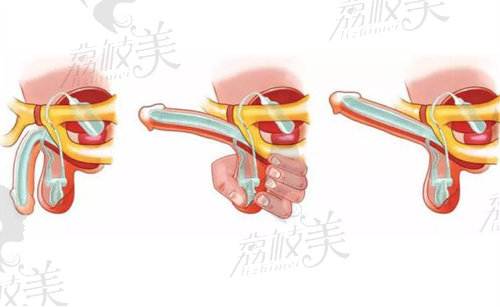 國內(nèi)男性陰莖假體植入好的醫(yī)院排名