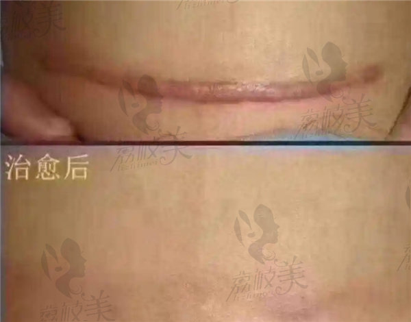 武晓莉近期疤痕修复范例