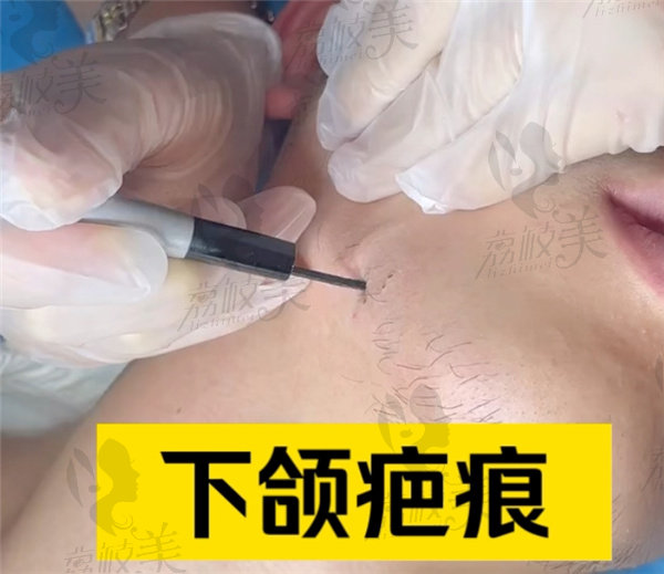 武晓莉近期疤痕修复范例