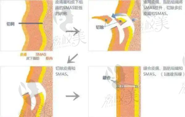 天津做筋膜提升医院怎么预约