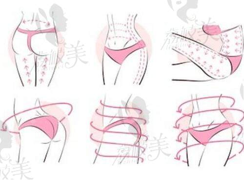  萬(wàn)友望醫(yī)生精通各種吸脂技術(shù)