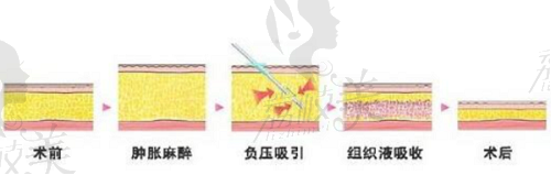 鄧晟華抽脂病例水動力吸脂反饋