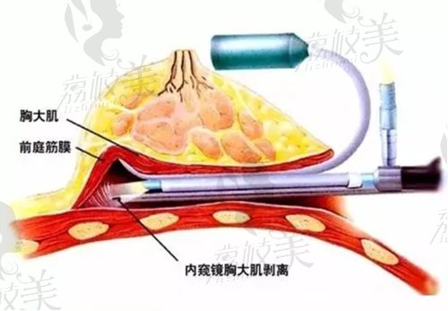 重慶陳德法隆胸怎么樣？