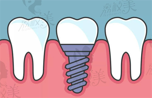 庆阳牙科医院种牙价格