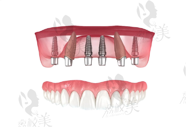 寧波恒美口腔種植牙怎么樣