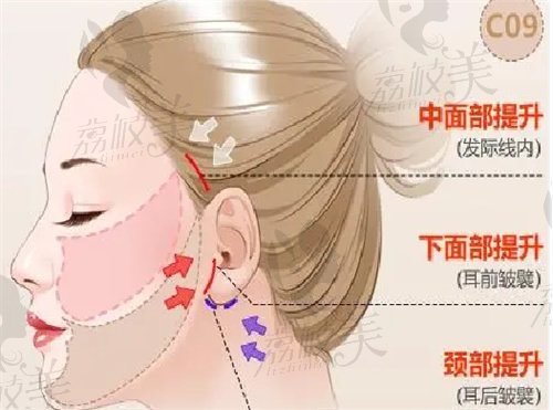 谢宏彬拉皮手术做的好吗