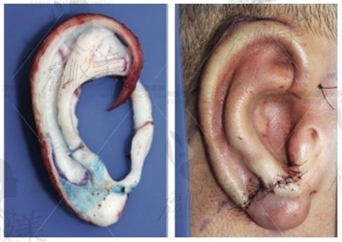 廣州高尚余文林院長耳朵再造技術真有那么好嗎？