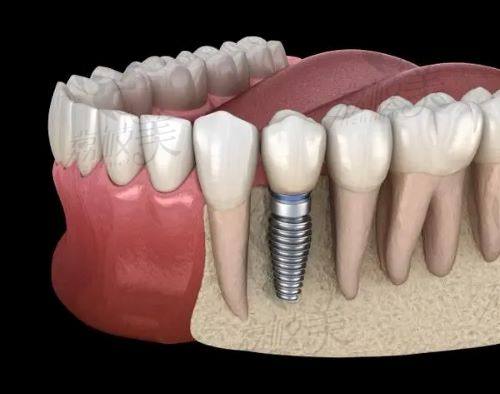 2025長(zhǎng)沙美奧口腔種植牙價(jià)格