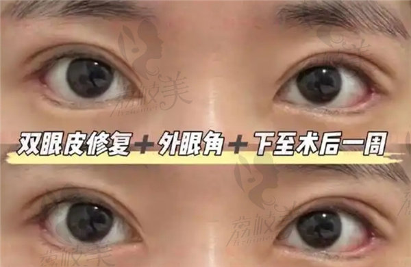 管果医生生眼综合/眼修复的真实范例