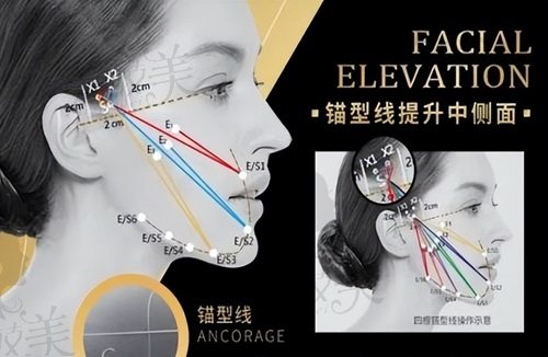 成都李建鋼無(wú)痕筋膜提升成效怎么樣？