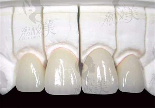 拉瓦牙冠屬于什么檔次