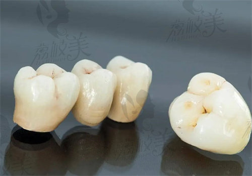 拉瓦牙冠屬于什么檔次