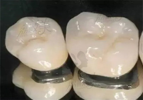 拉瓦牙冠屬于什么檔次